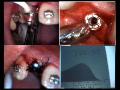 Isq 55 dans os modifié par ortho pj6ubs - Eugenol