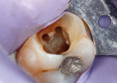 Image3 ixfirb - Eugenol