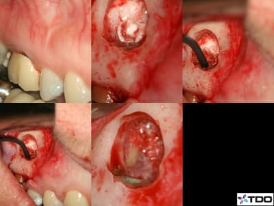 Images resection dvkuzc - Eugenol