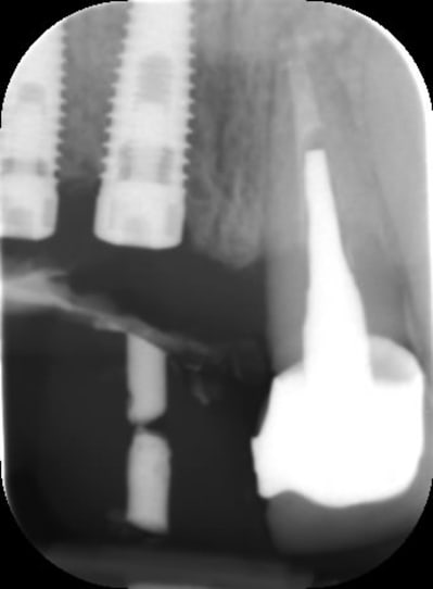 Implant guide hot8o2 - Eugenol