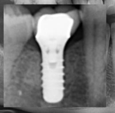 Implant2 jg2xex - Eugenol