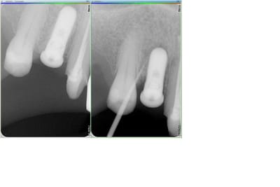 Implant 14 p7jtjv - Eugenol