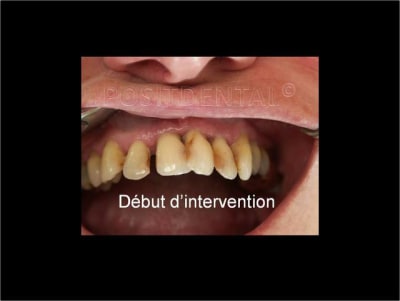Implant dentsply ankylos et mci 10 dv2gys - Eugenol