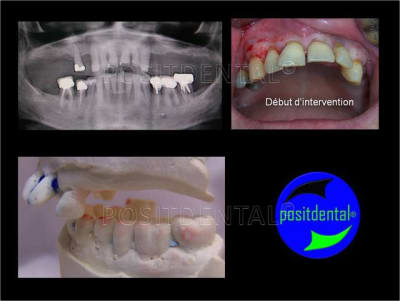 Implant l one et mci post extrationnelle  mcipe 001 brksyl - Eugenol