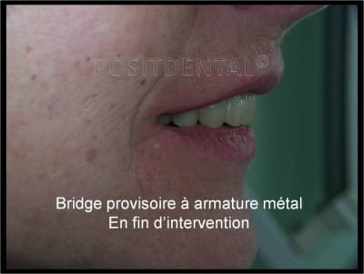Implant l one et mci post extrationnelle  mcipe 005 z3lmtl - Eugenol