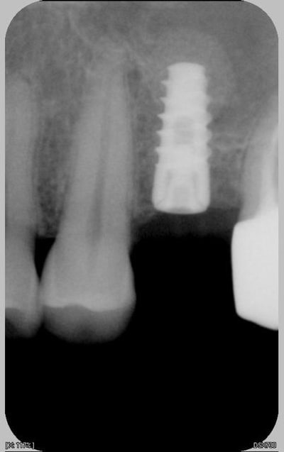 Implant seven 10x4 - Eugenol