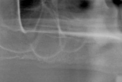 Implant dans septum sinusien ps2ffz - Eugenol