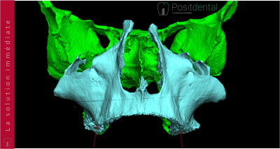 Implants ptérygoïdien 002 rifusy - Eugenol