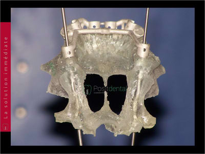 Implants ptérygoïdien 033 qgyd0t - Eugenol