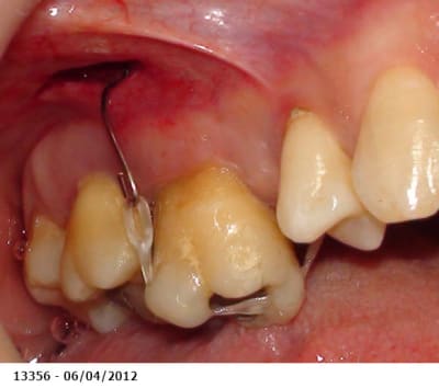 Ingression molaire0 mllgew - Eugenol