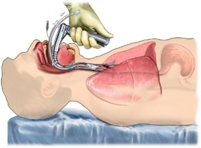 Intubation xzik6c - Eugenol