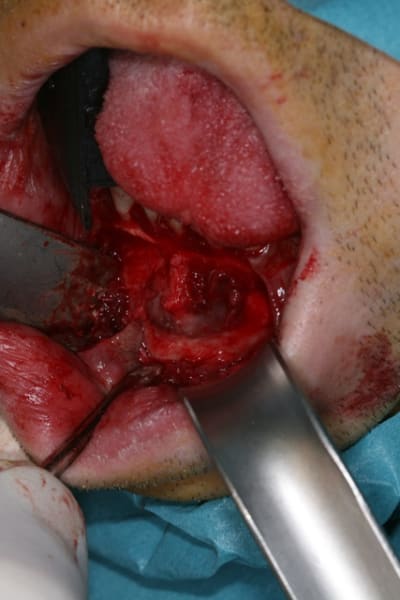 Kyste mand02 od1uwd - Eugenol