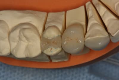 Labo occlusal 25 jvxwdg - Eugenol
