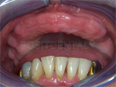 Lambeau   minima avec un guide chirurgical   appuis osseux 01 g5yvio - Eugenol