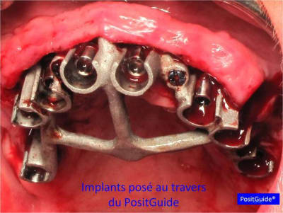 Lambeau   minima avec un guide chirurgical   appuis osseux 04 m6ueoz - Eugenol
