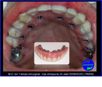 M.c.i en 1 temps chirurgical  - Eugenol