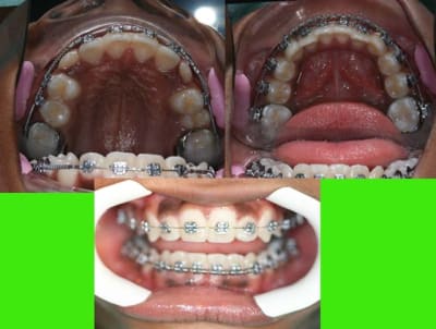 Materiel  1 efp0tb - Eugenol