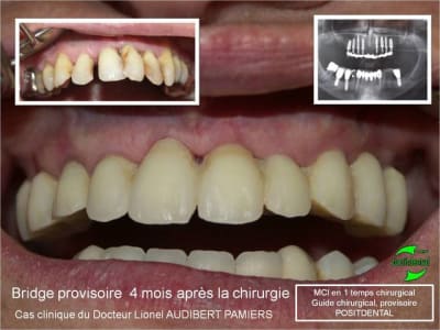 Mci en 1 temps chirurgical 1 ogel86 - Eugenol