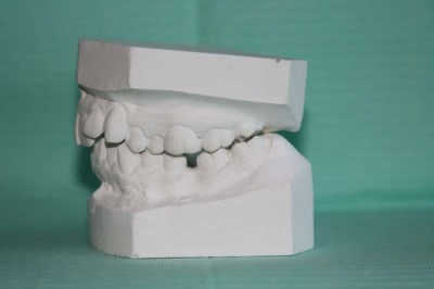 Moulage 2 dllhb9 - Eugenol