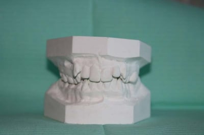 Moulage 4 etnevt - Eugenol