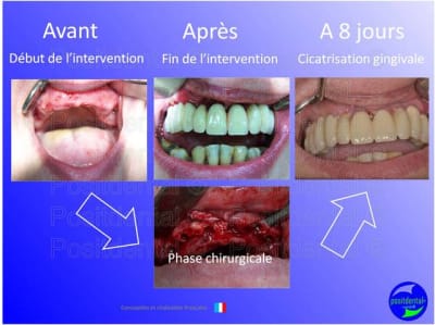 Mise en chage imm diate 034 gczpbk - Eugenol