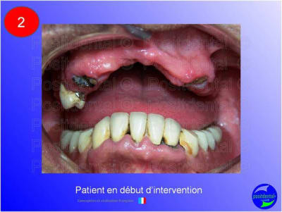 Mise en chage imm diate 182 pl8mxo - Eugenol