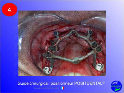 Mise en chage imm diate 184 i93ewg - Eugenol