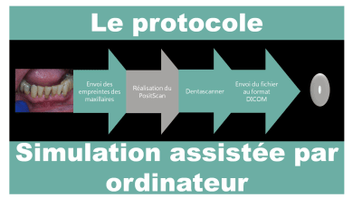 Mise en charge immédiate   protocole positdental 005 birg5o - Eugenol