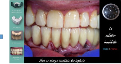 Mise en charge immédiate   protocole positdental 020 to1xcd - Eugenol