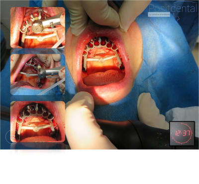 Mise en charge immédiate   chirurgie guidée 12 dziqzz - Eugenol