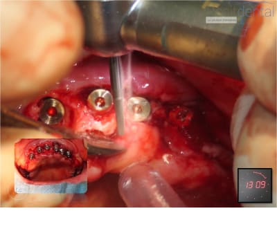 Mise en charge immédiate   chirurgie guidée 14 w3wakb - Eugenol