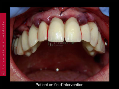 Mise en charge immédiate   chirurgie guidée guide chirurgical 002 zcqmjr - Eugenol