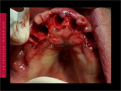 Mise en charge immédiate   chirurgie guidée guide chirurgical 017 tqnrpm - Eugenol