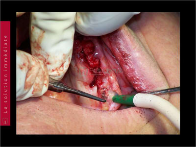 Mise en charge immédiate   chirurgie guidée guide chirurgical 020 yvvyvb - Eugenol