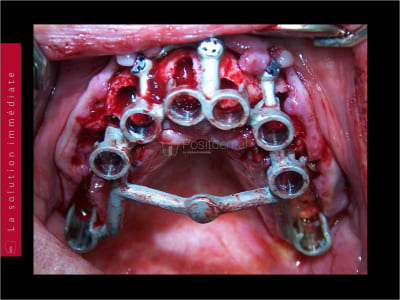 Mise en charge immédiate   chirurgie guidée guide chirurgical 036 zct8xe - Eugenol