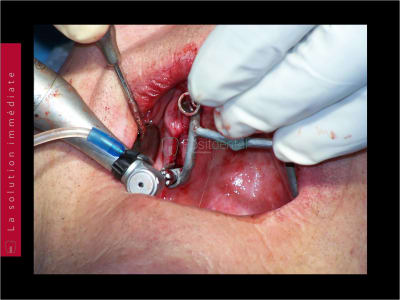 Mise en charge immédiate   chirurgie guidée guide chirurgical 046 ebir5c - Eugenol