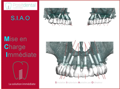 Mise en charge immédiate 004 bfgase - Eugenol