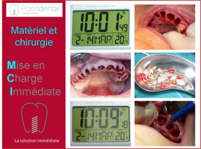 Mise en charge immédiate 006 tsfidn - Eugenol