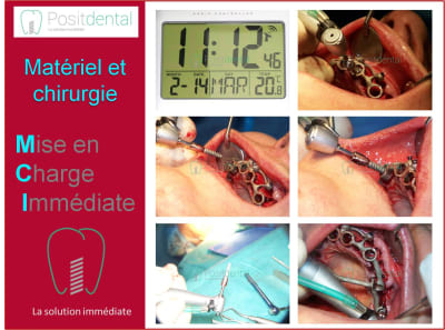 Mise en charge immédiate 008 smesho - Eugenol