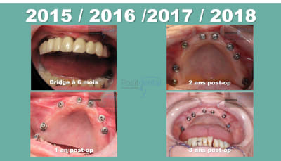 Mise en charge immédiate positdental 03 bjh3u4 - Eugenol