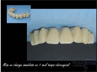 Mise en charge immédiate chirurgie guidée 013 qijpzi - Eugenol