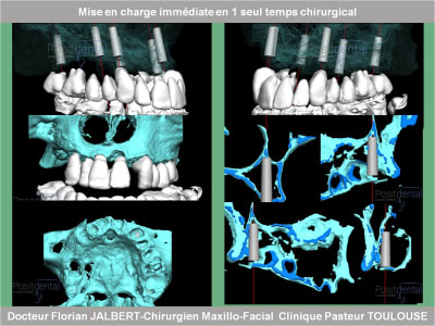 Mise en charge immédiate en 1 seul temps chirurgical protocole positdental 050 kuifvo - Eugenol