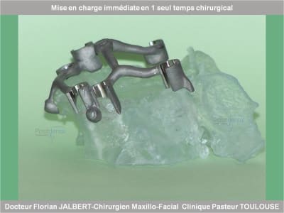 Mise en charge immédiate en 1 seul temps chirurgical protocole positdental 054 hyszdm - Eugenol