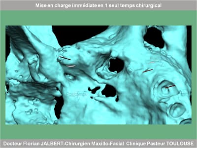 Mise en charge immédiate en 1 seul temps chirurgical protocole positdental 057 xu7jmw - Eugenol