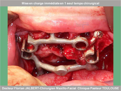 Mise en charge immédiate en 1 seul temps chirurgical protocole positdental 061 canlx0 - Eugenol