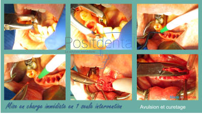 Mise en charge immédiate en 1 seule intervention la solution immédiate positdental 003 qhi80s - Eugenol