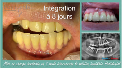 Mise en charge immédiate en 1 seule intervention la solution immédiate positdental 012 pyru8b - Eugenol