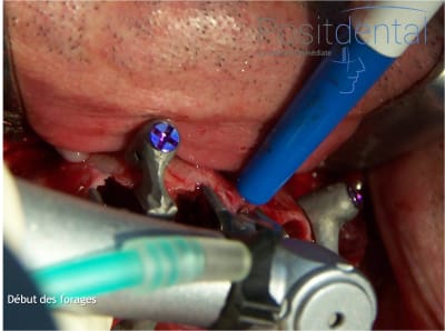 Mise en charge immédiate en chirurgie guidée   positdental 011 tgexxr - Eugenol