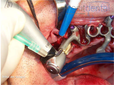 Mise en charge immédiate en chirurgie guidée   positdental 015 fnexl2 - Eugenol