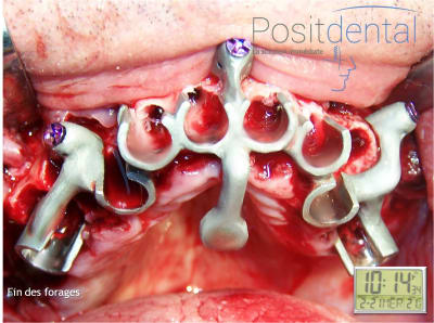 Mise en charge immédiate en chirurgie guidée   positdental 016 kxbtxb - Eugenol